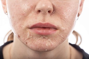 Tái Tạo Da Là Gì Và Các Phương Pháp Tái Tạo Da Phổ Biến